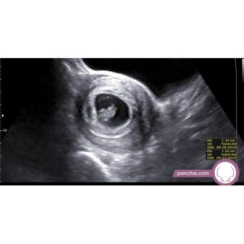 Meet Your Baby Ultrasound