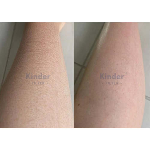 Kinder Filter - Clinically Tested Bath Filter for Healthier Skin
