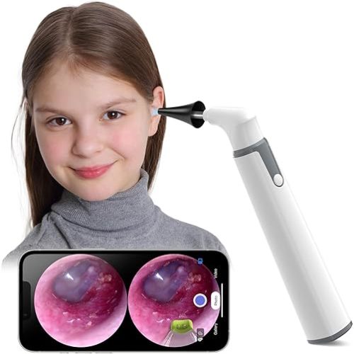 ScopeAround Otoscope with Light, Otoscope Camera w/Dual View, 720pHD WiFi Ear Scope w/ 6 LED Lights, Ear Camera 3.9mm Lens for Kids & Adults, Ear Scope Compatible w/Android & iPhone