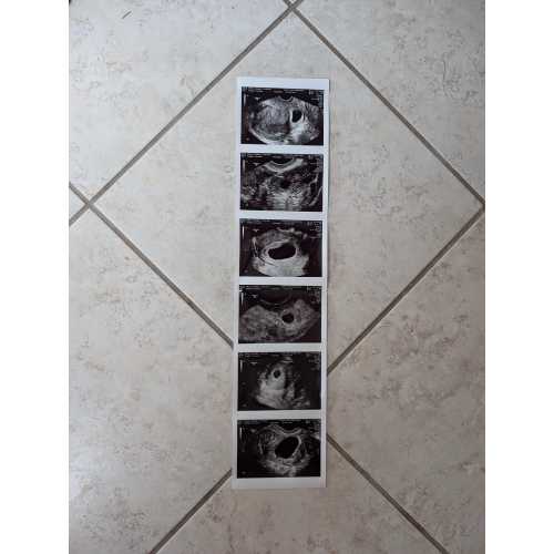 Pregnancy Keepsake - Your Ultrasound Image Print Outs on REAL MEDICAL GRADE Ultrasound Paper