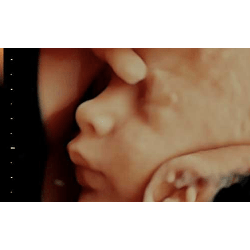 HD Ultrasound 24-34 Weeks