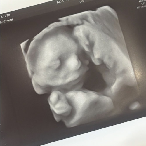 3D/4D Ultrasound Fund
