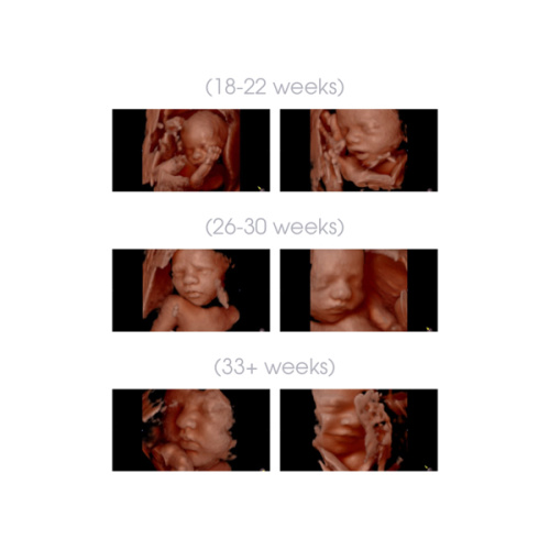 Atlanta - Little Bellies Ultrasound 2D/3D/4D - 5D/HD & Pregnancy Spa