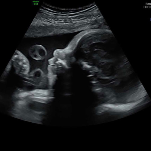 Nighttime Doula Support Fund