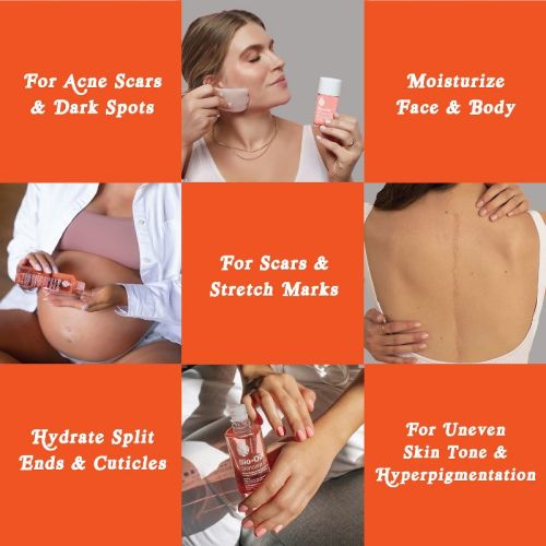 Bio-oil Skincare Oil For Scars And Stretchmarks, Serum Hydrates Skin, Reduce Appearance Of Scars Calendula - 6.7 Fl Oz