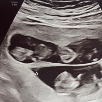 Shatzkes Triplets Baby Registry Photo.