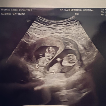Thomas Twins Photo.